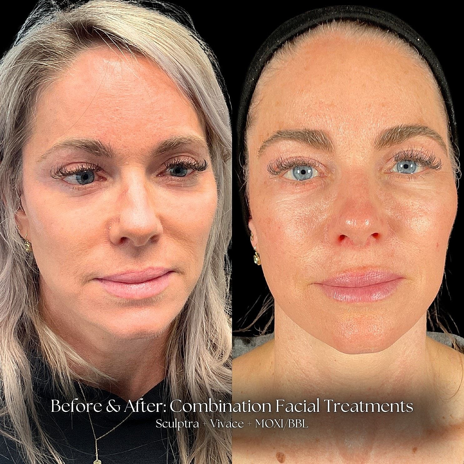 Before and after facial treatment results comparison