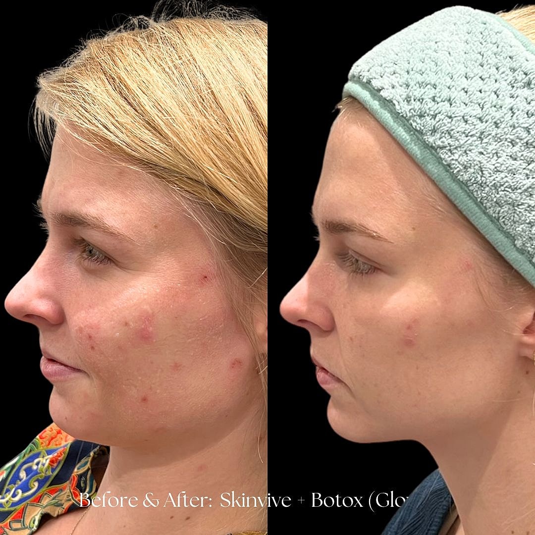 Before and after skincare treatment comparison