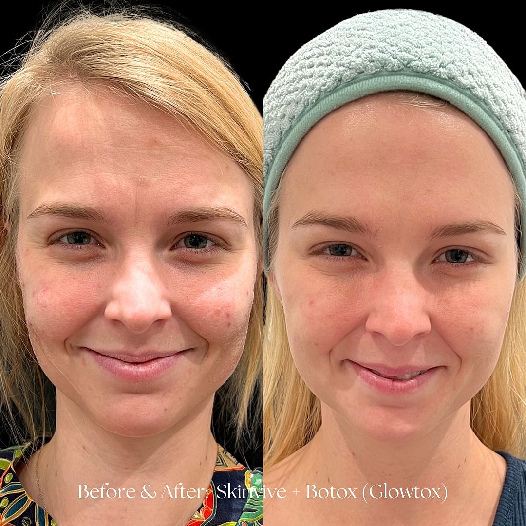 Skin rejuvenation before and after treatment comparison.