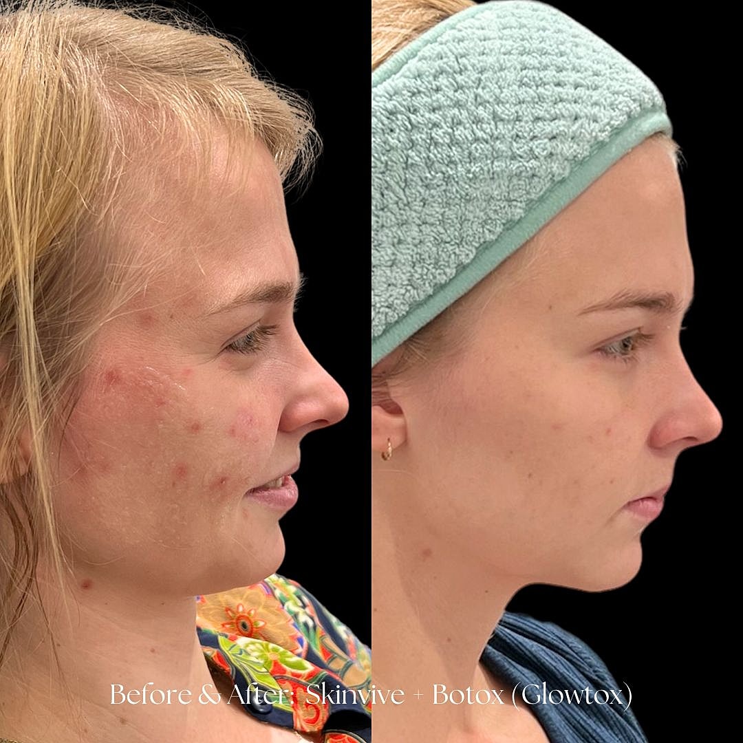 Before and after skincare treatment results.