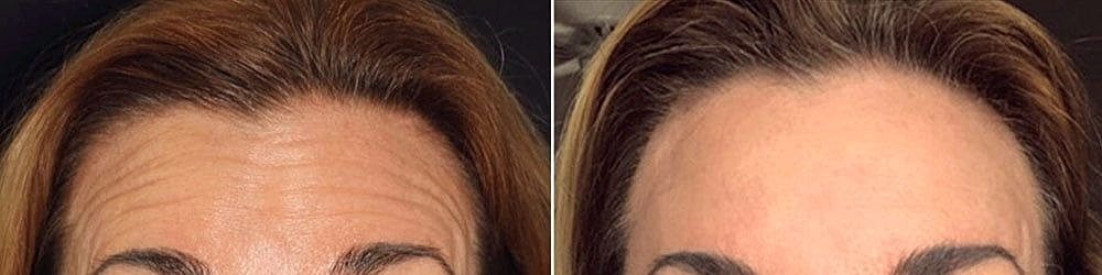 Botox Before & After