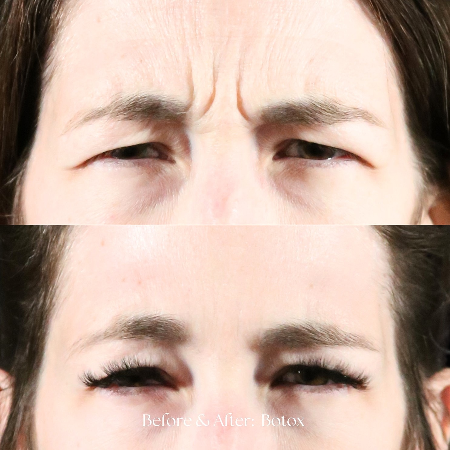 Botox Before & After
