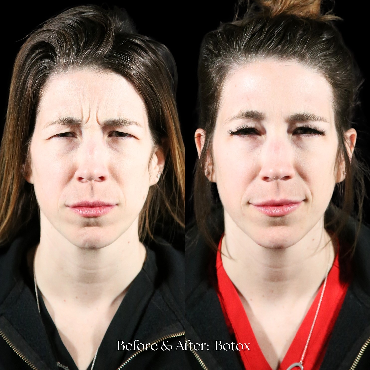 Botox Before & After