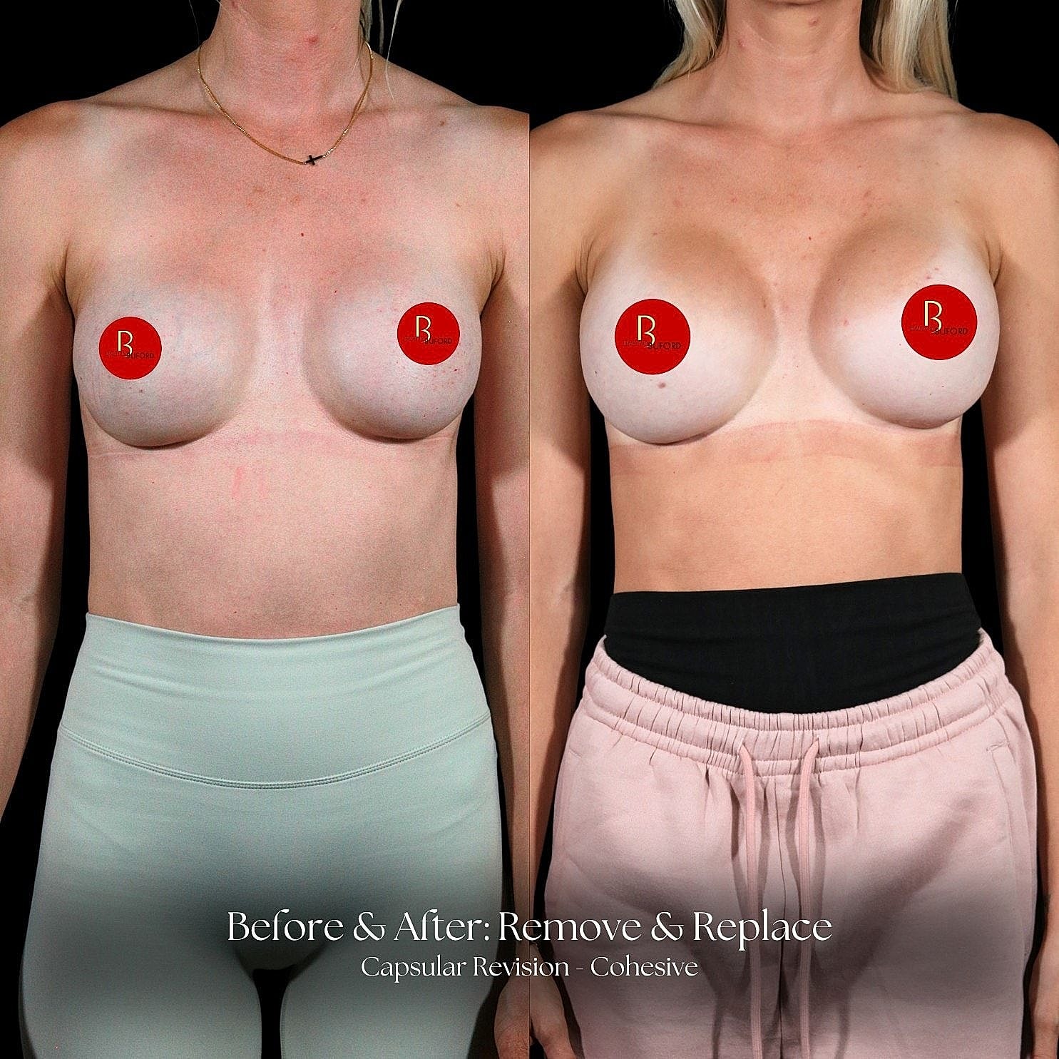 Breast surgery before and after comparison image.