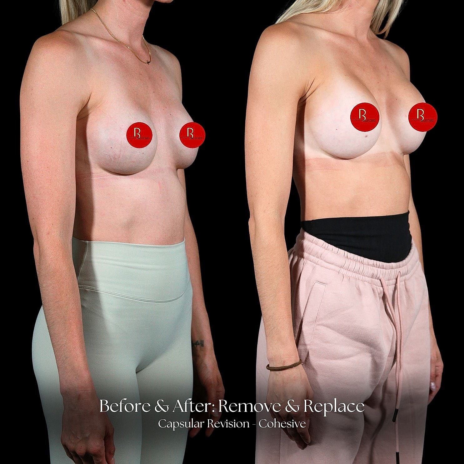 Before and after capsular revision procedure comparison.