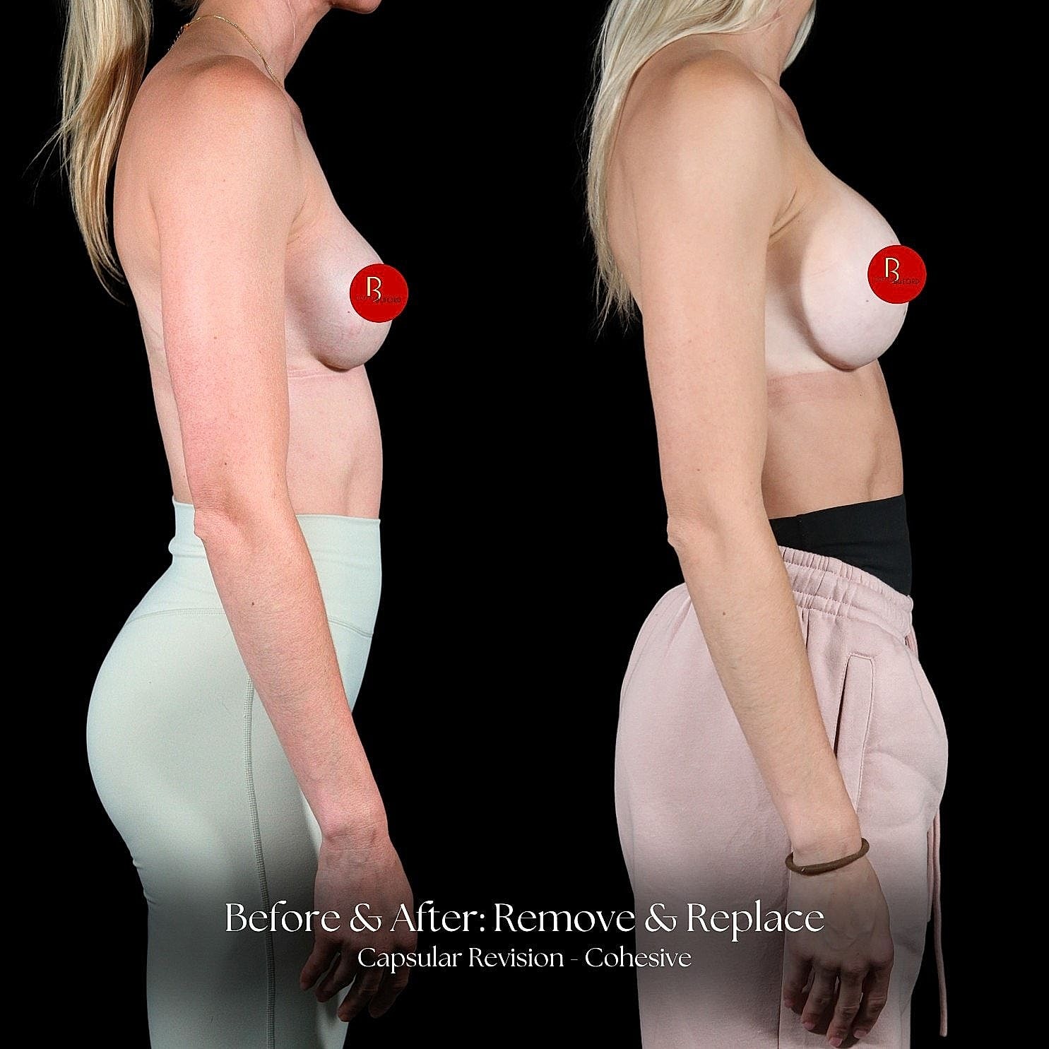 Breast augmentation before and after comparison photo.