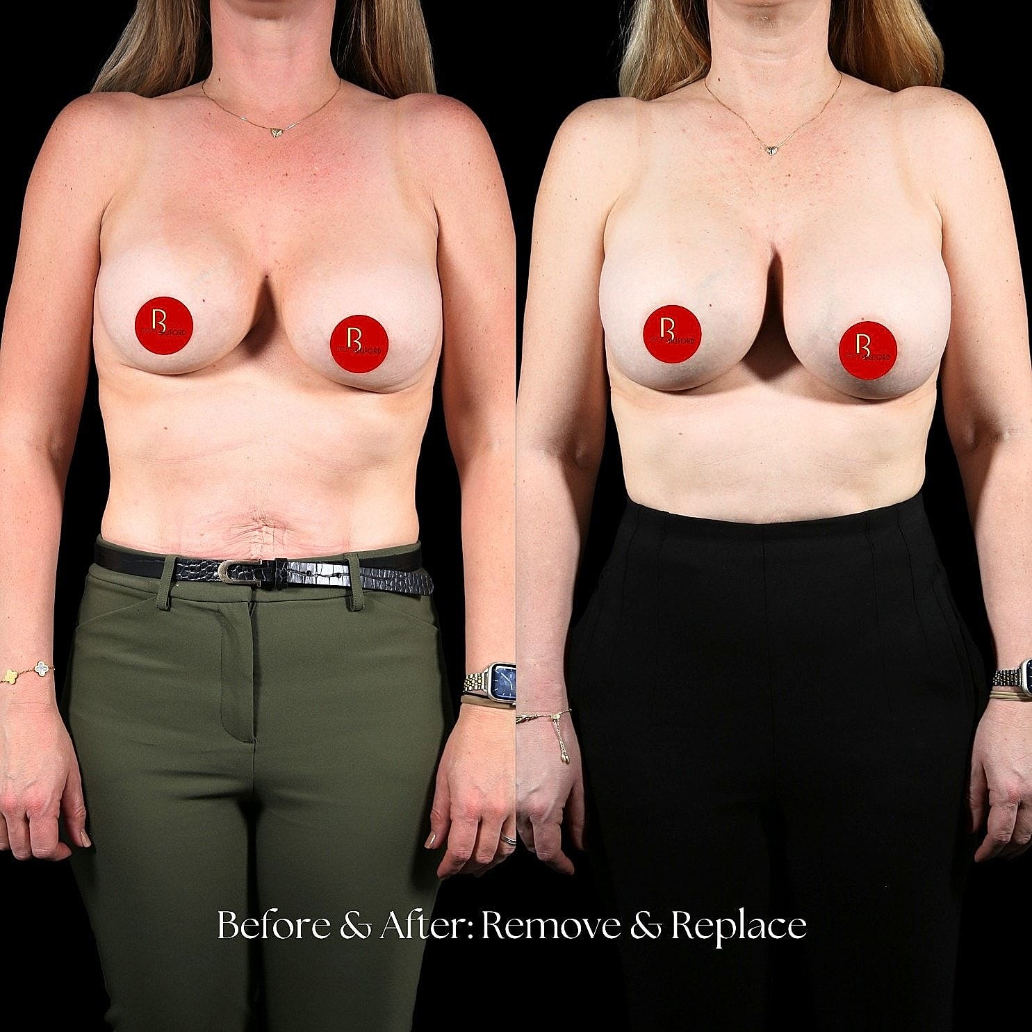 Breast augmentation before and after comparison.