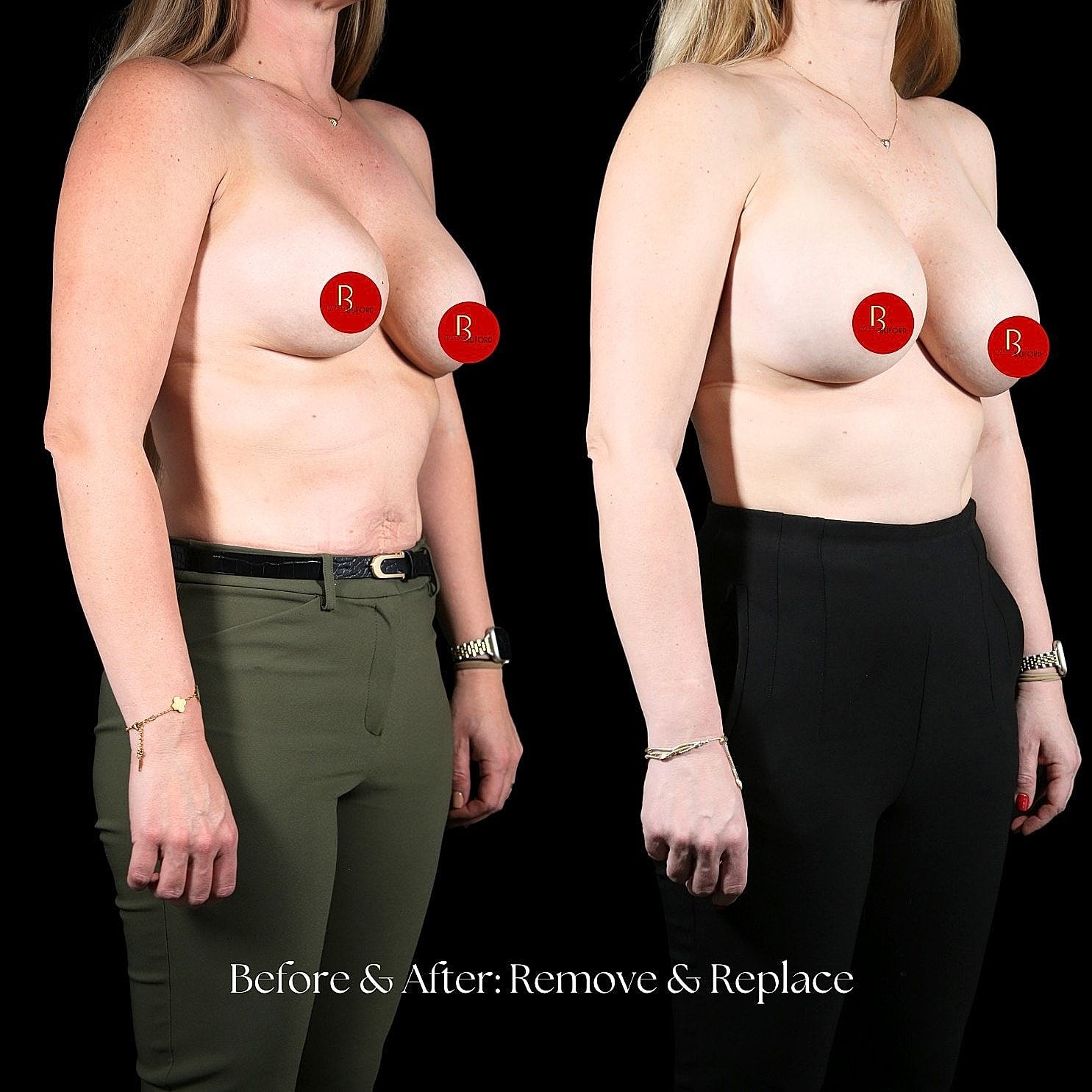 Breast implant removal and replacement comparison.