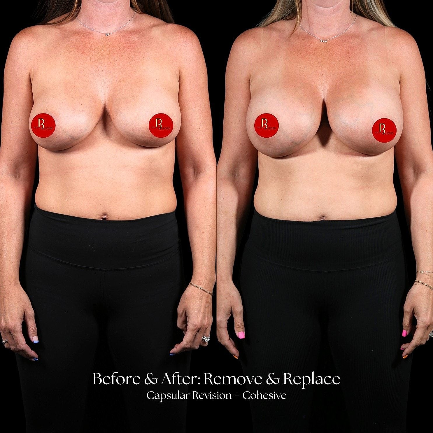 Breast surgery before and after photos.