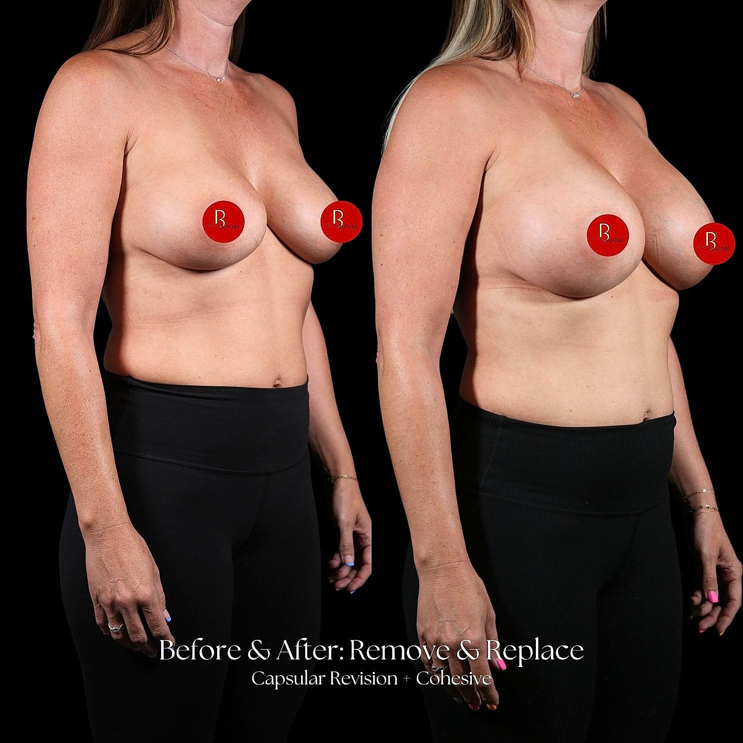 Before and after breast enhancement transformation image