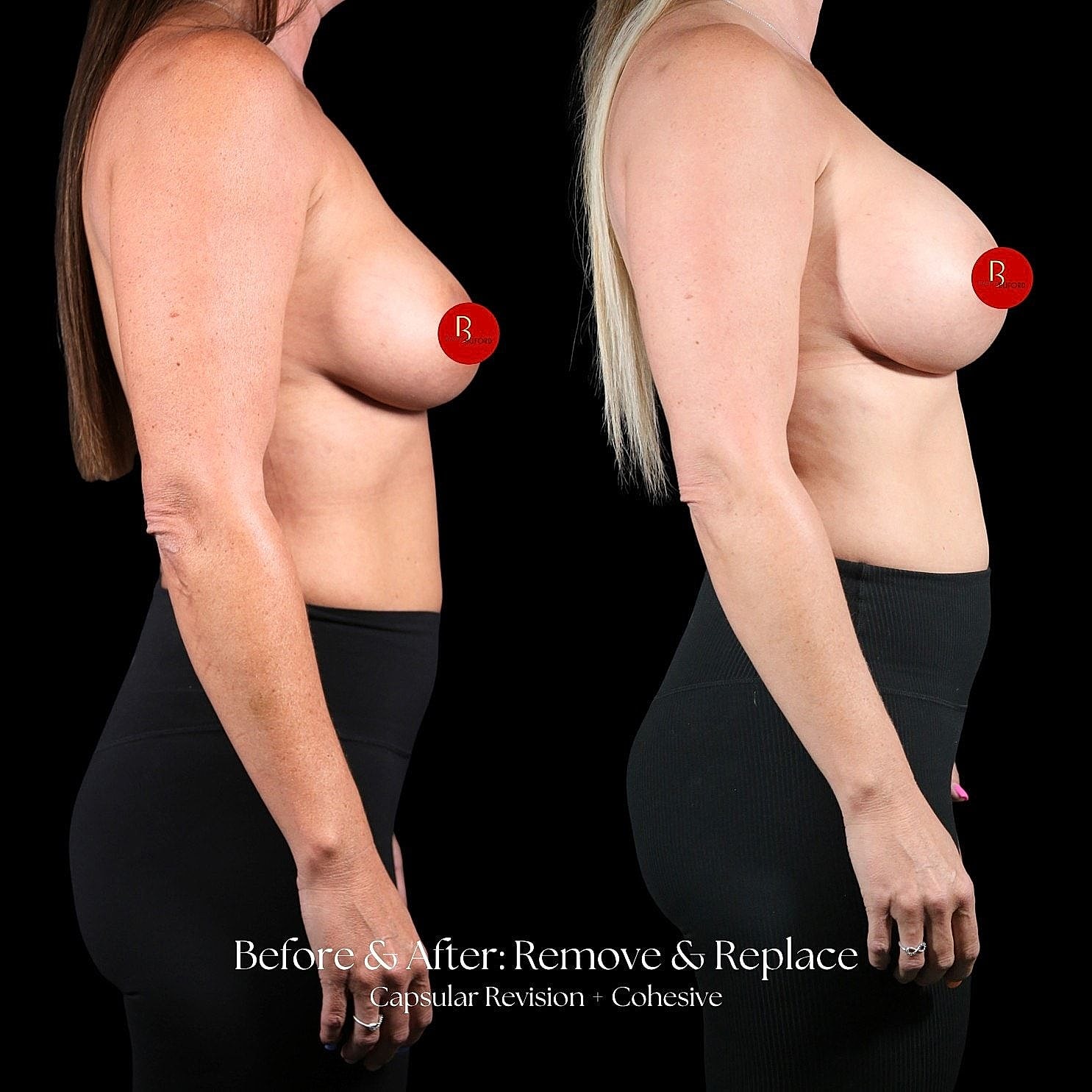 Before and after breast enhancement results comparison.