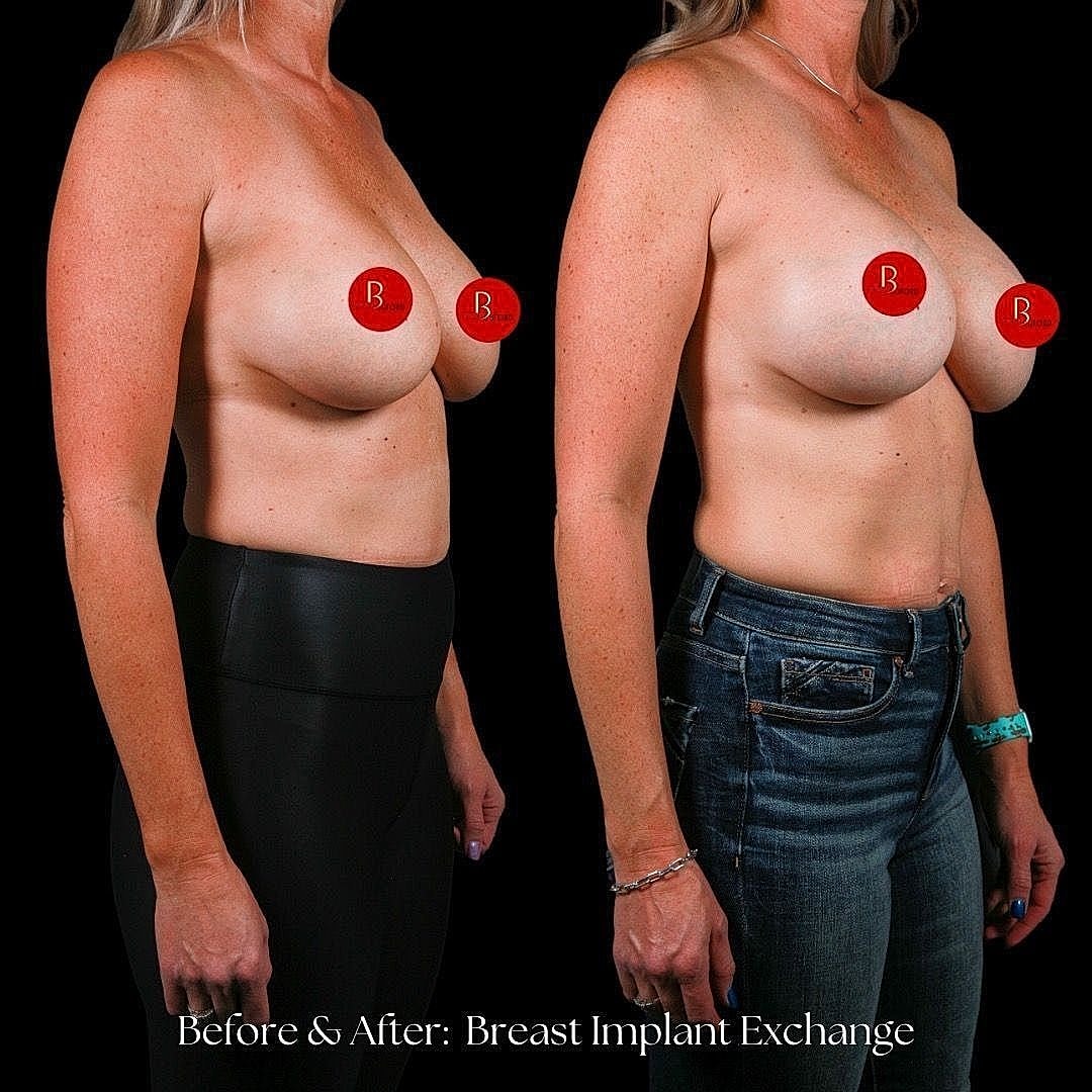 Breast implant exchange before and after results.