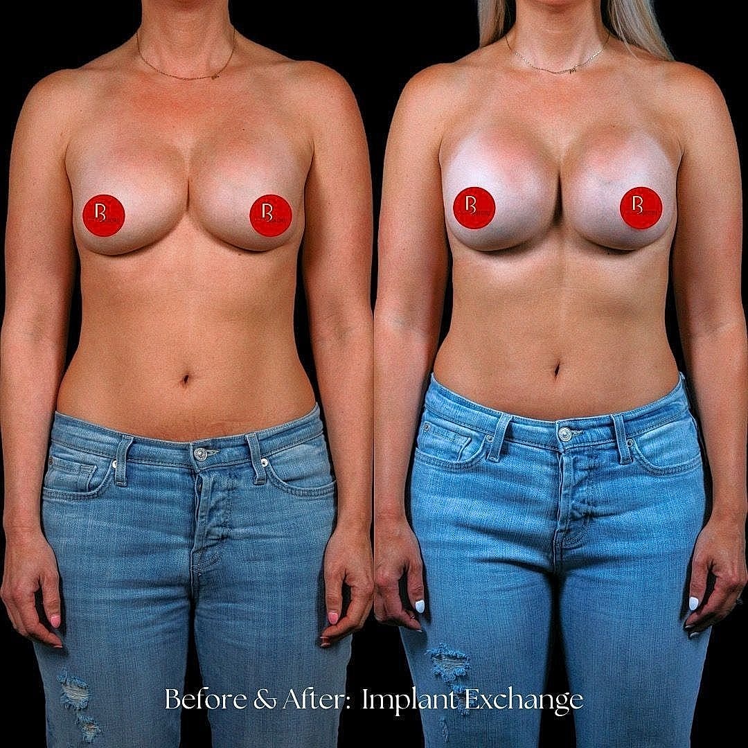 Before and after breast implant exchange comparison.