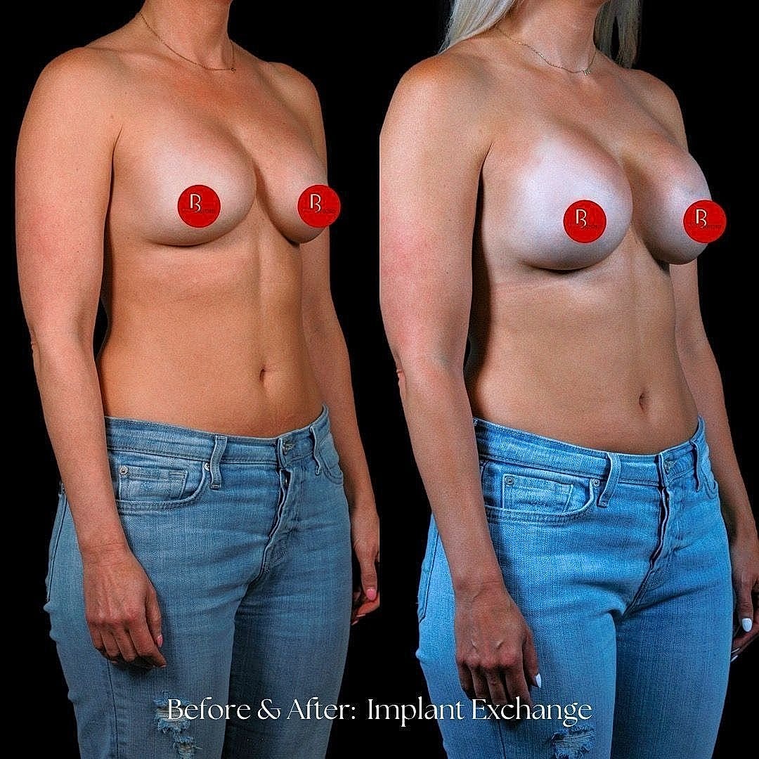Breast implant exchange before and after images
