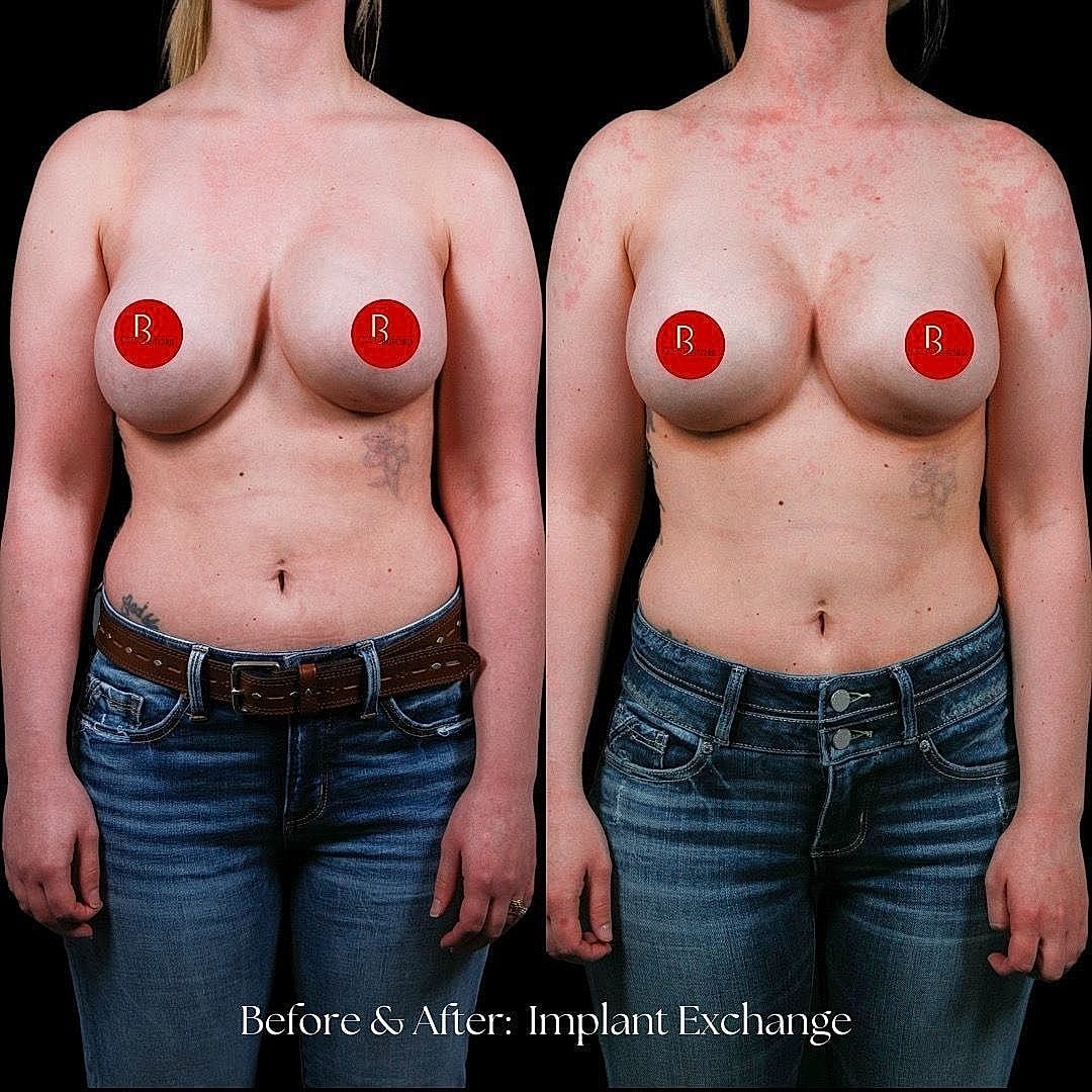 Before and after breast implant exchange comparison.