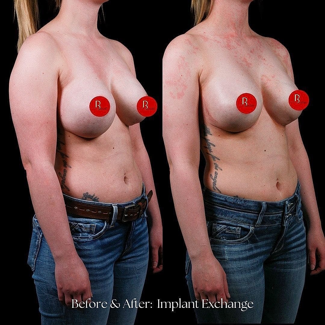 Breast implant exchange before and after comparison.