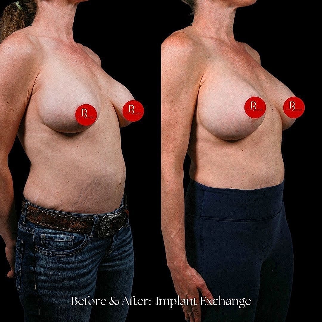 Before and after breast implant exchange comparison.