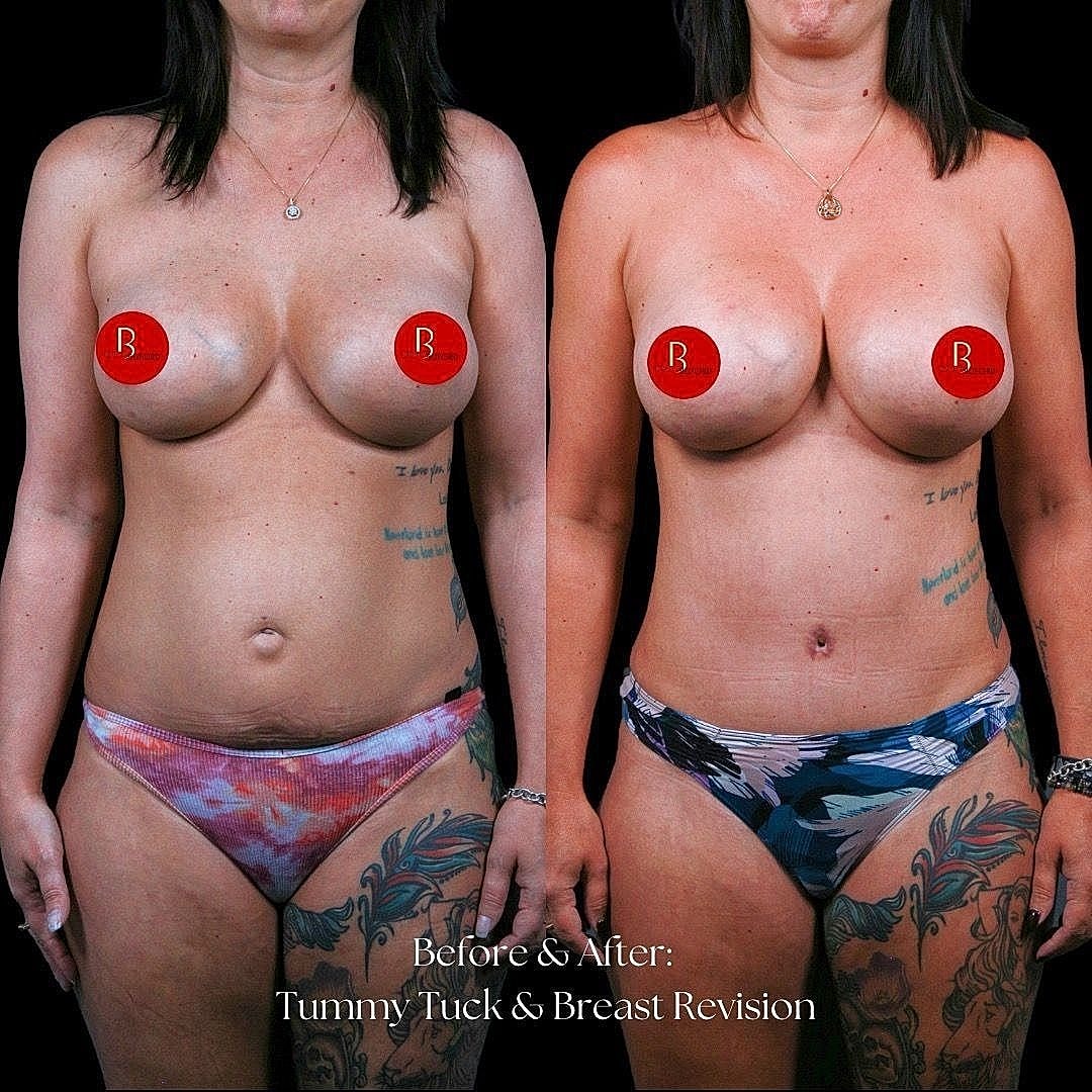 Before and after tummy tuck and breast revision