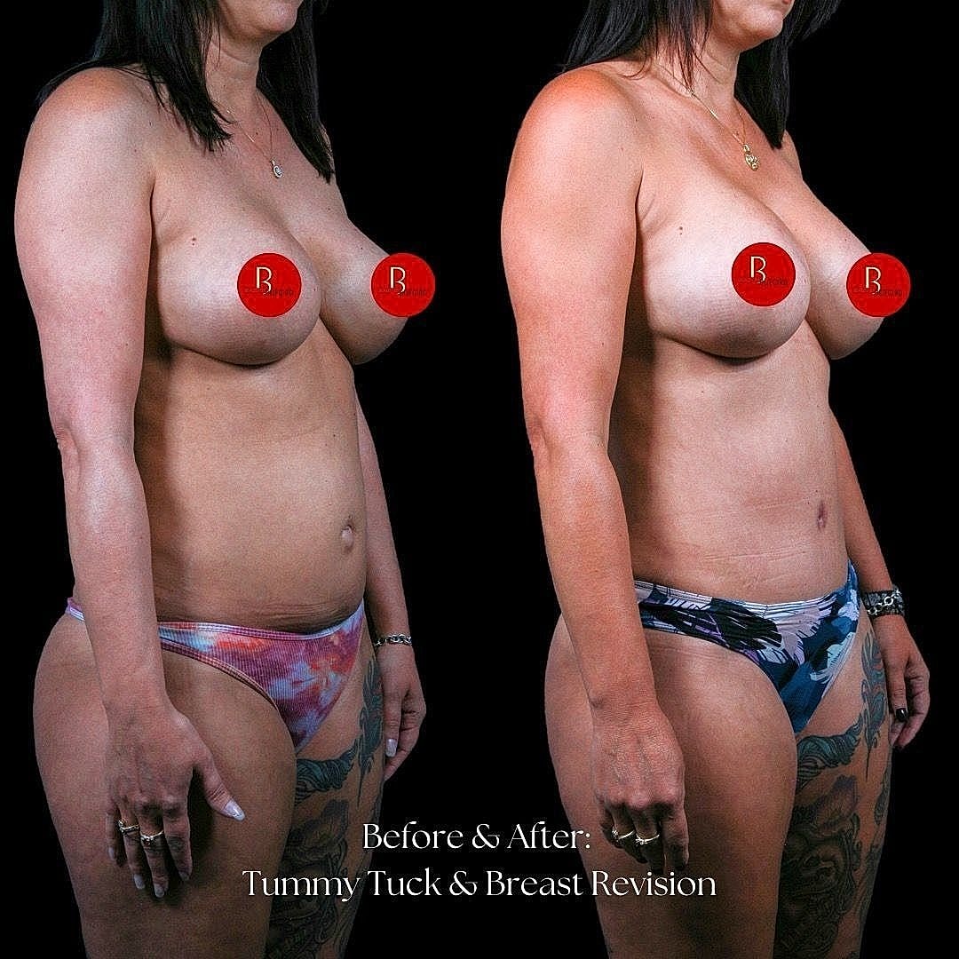 Before and after of body contouring procedure.