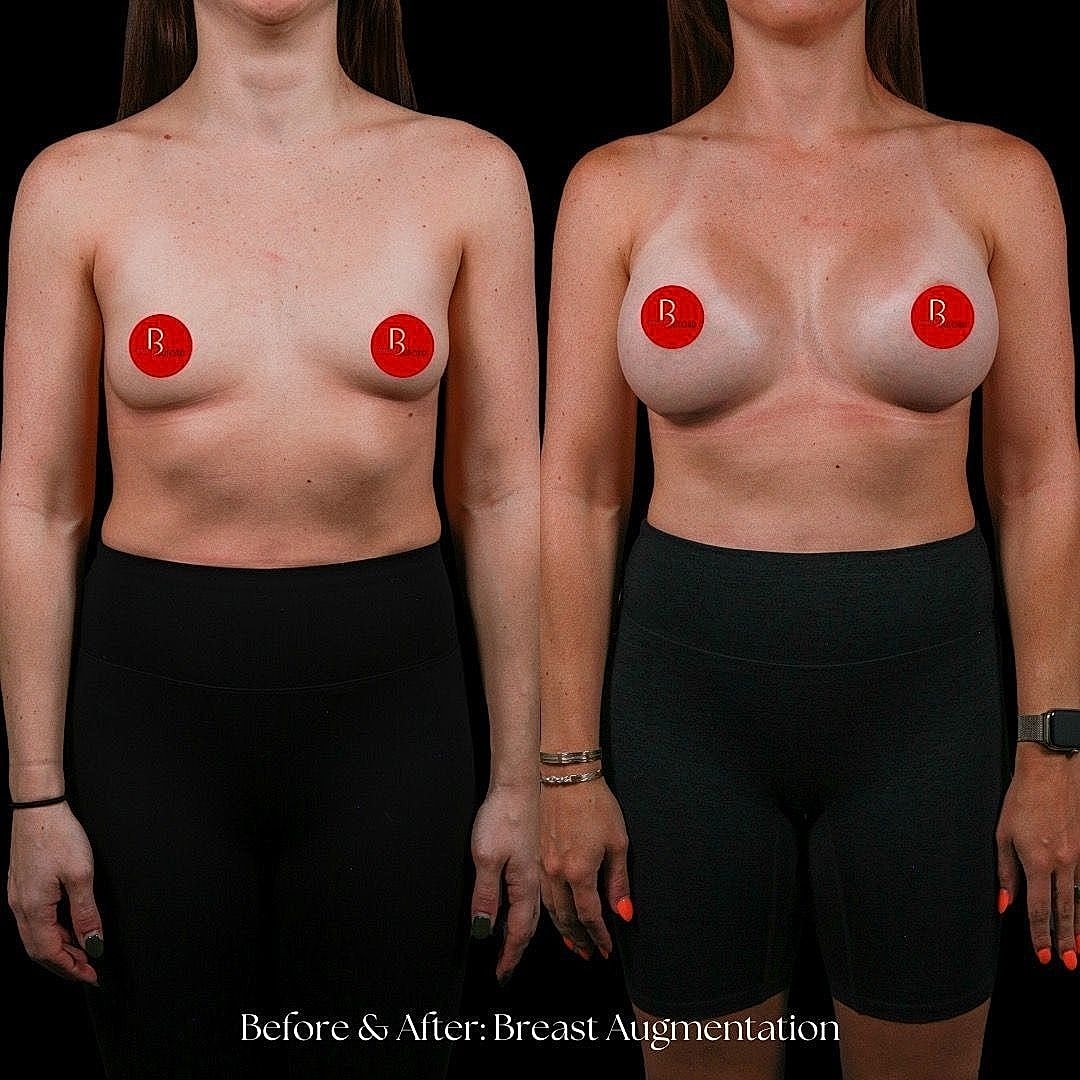 Before and after breast augmentation comparison image.