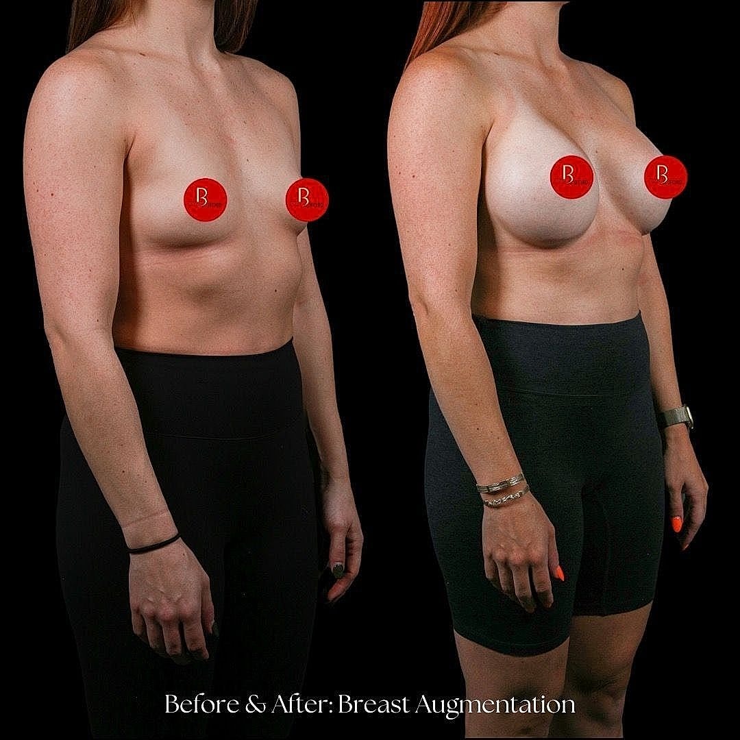 Before and after breast augmentation comparison photo