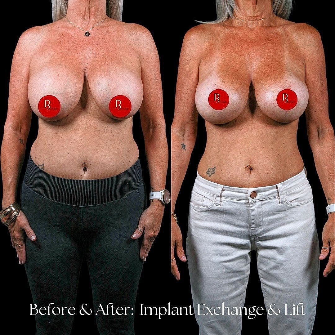 Before and after breast implant exchange and lift.