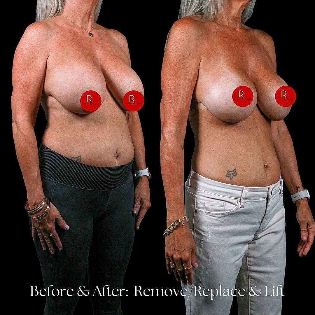Before and after breast enhancement procedure comparison.