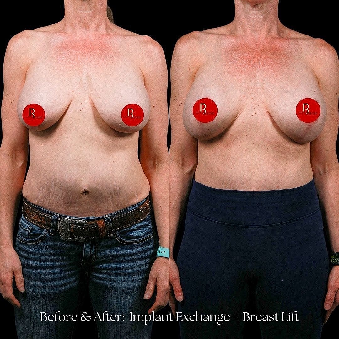 Breast augmentation before and after comparison.