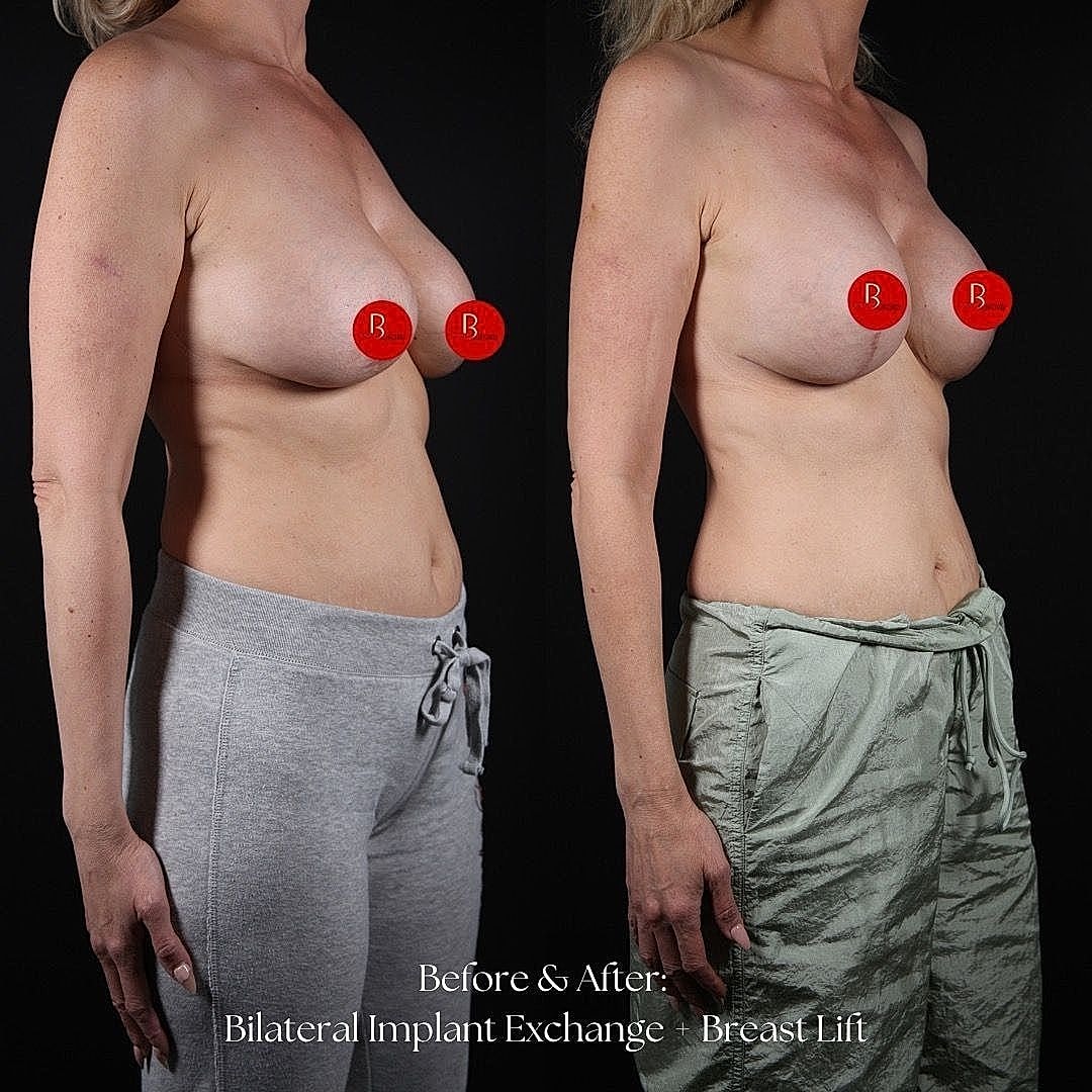 Bilateral implant exchange and breast lift comparison.