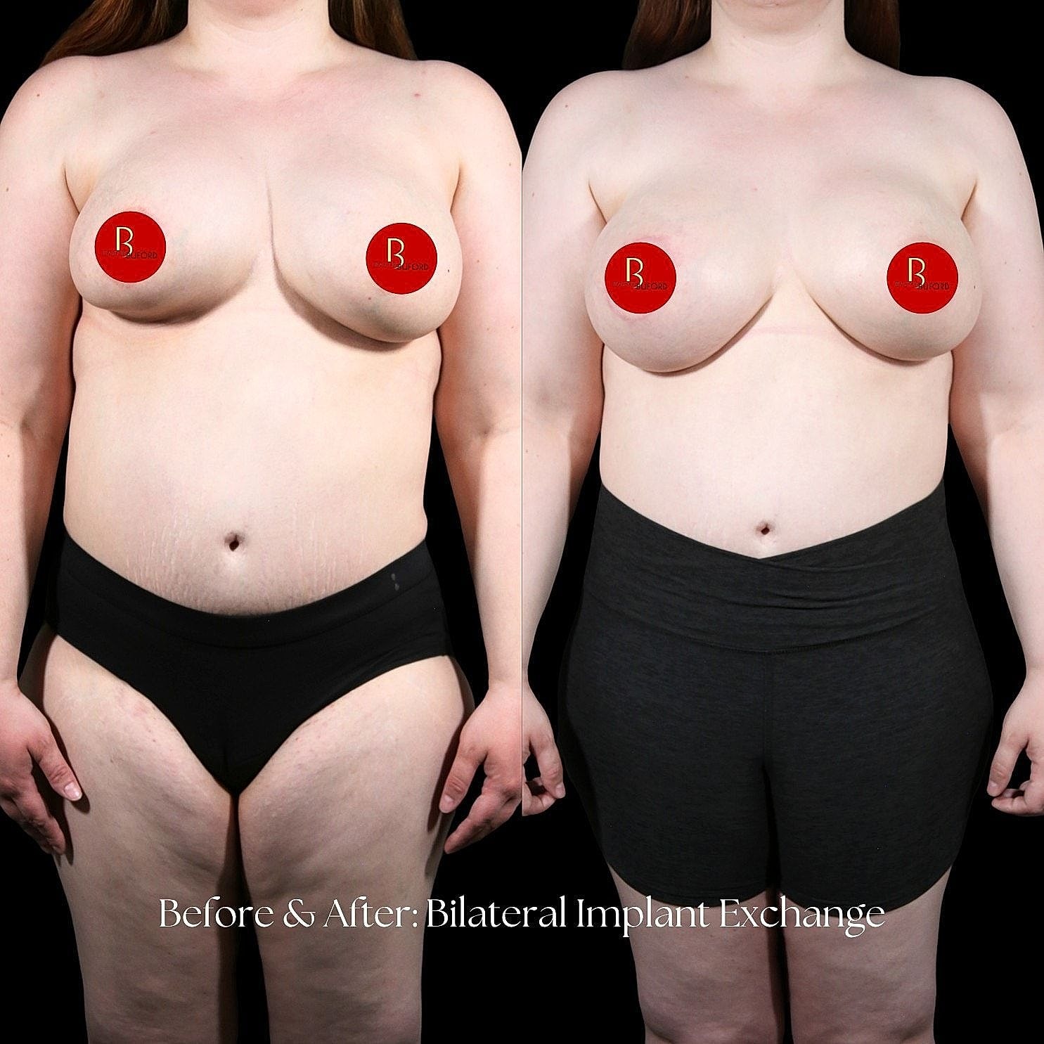 Before and after bilateral implant exchange comparison.