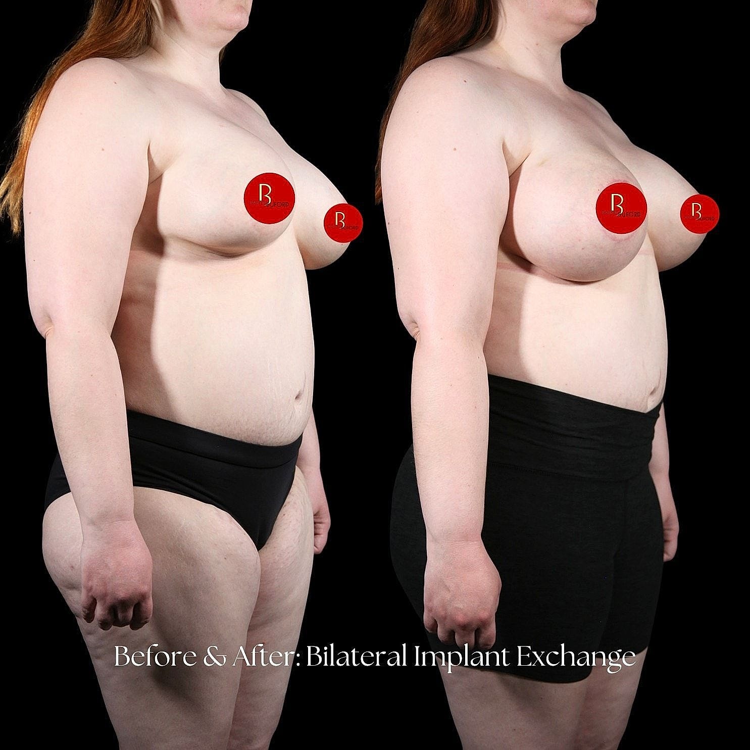 Before and after bilateral implant exchange photos.