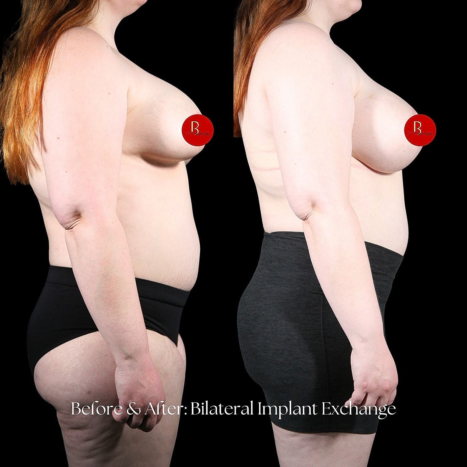 Bilateral breast implant exchange before and after comparison.