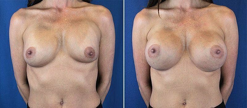 Before and after breast augmentation comparison image.
