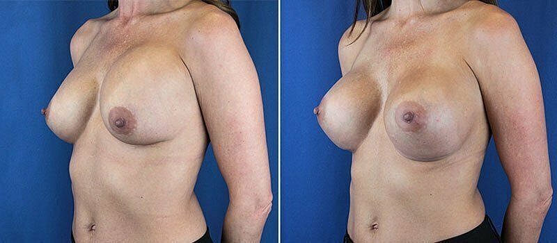 Before and after breast augmentation photos.