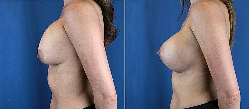 Before and after breast augmentation comparison photo.