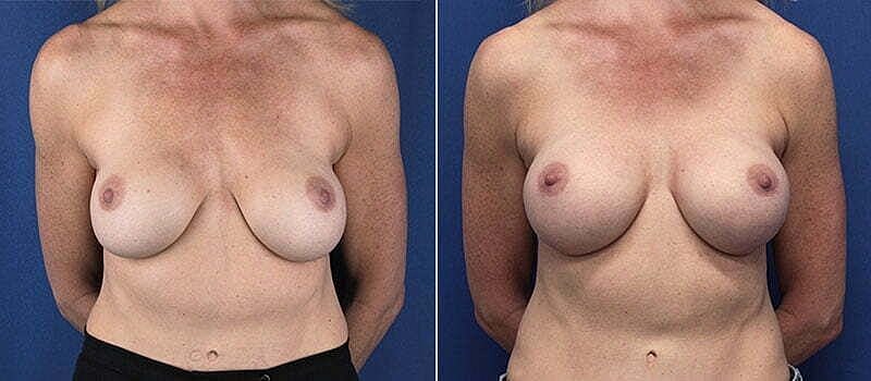 Comparison of breast appearance before and after.