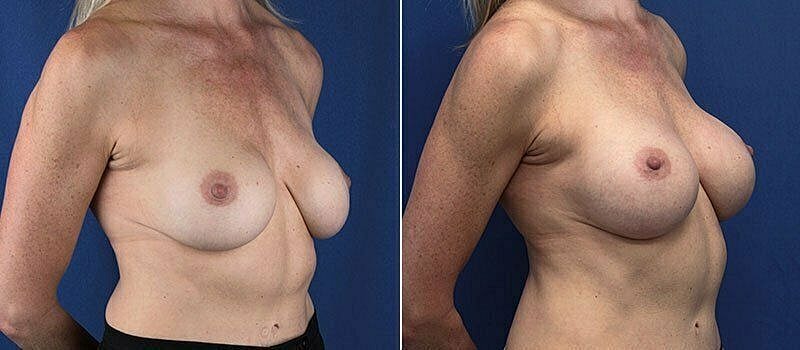 Before and after breast augmentation comparison image.