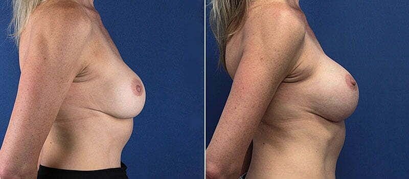 Before and after breast enhancement comparison image