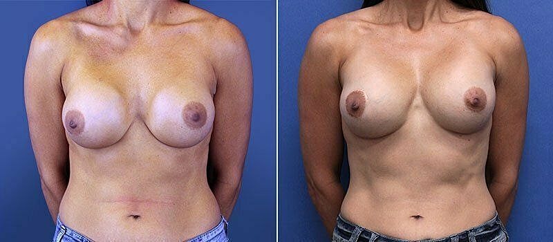 Before and after body transformation comparison