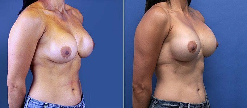 Before and after breast augmentation comparison.