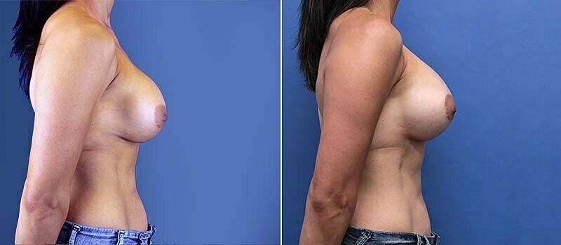 Before and after breast augmentation comparison image.