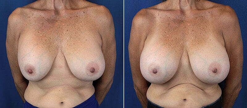 Before and after breast procedure comparison image
