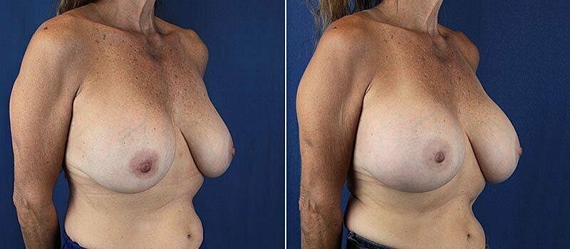 Before and after breast augmentation comparison.
