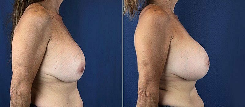 Before and after breast augmentation comparison image