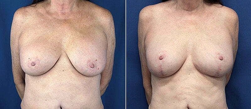 Breast comparison before and after procedure.