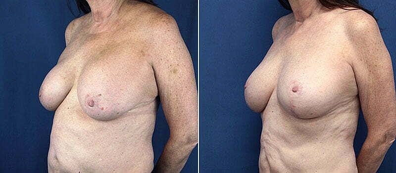 Before and after body contouring comparison.