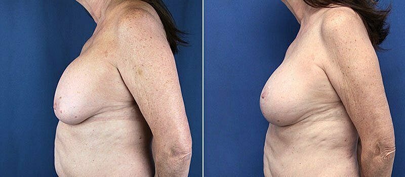 Before and after breast enhancement comparison image.