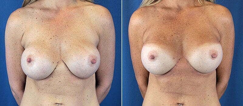Before and after breast augmentation comparison image.