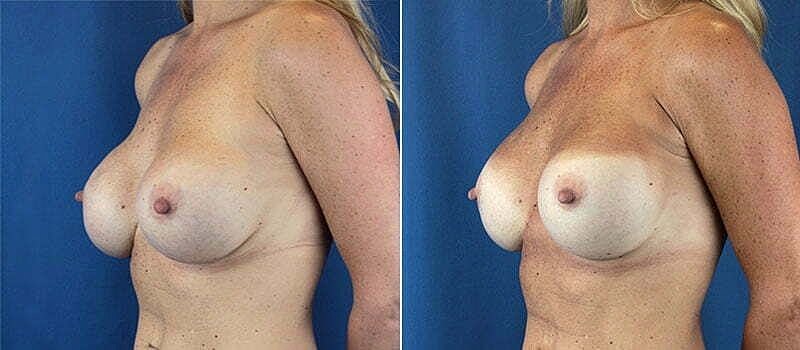 Breast reconstruction before and after photos.