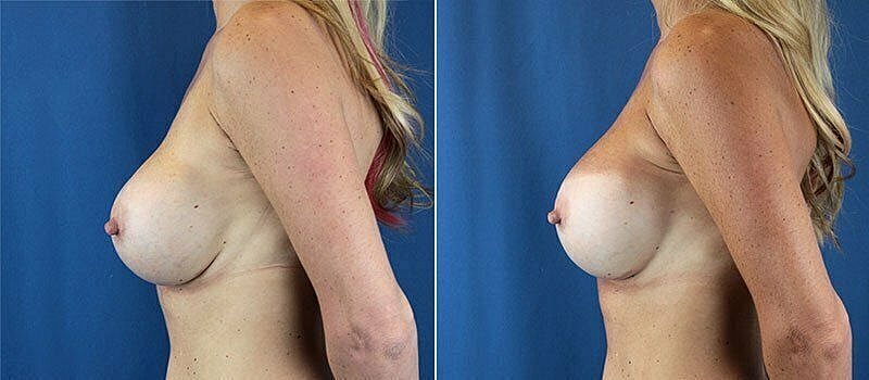 Before and after breast aesthetic comparison images